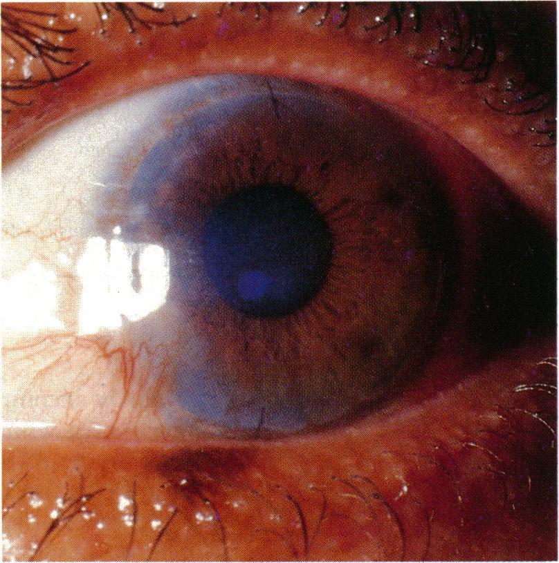 Deep lamellar keratoplasty on air with lyophilised tissue 647 Vt::.. Figure 2 A patient's cornea with central stromal scarring is suitable for this technique. Air is injected and a lamella resected.