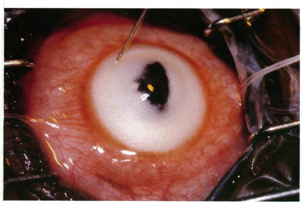 We present our experimental work on human cadaver corneas and the results of using the technique in a series of four patients with different corneal pathologies.