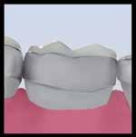 occlusal and gingival interferences