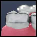 occlusal and gingival interferences