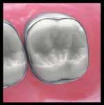 for reduced separation Increased occlusal edge