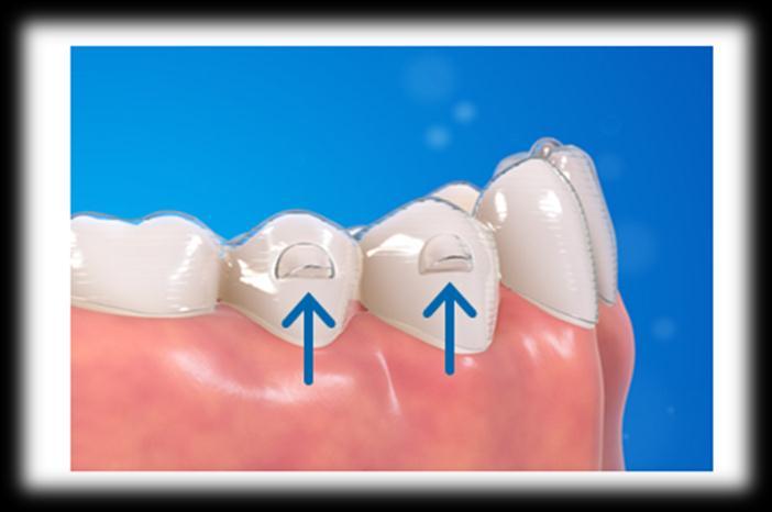 premolar extrusion for more predictable deep bite treatments.