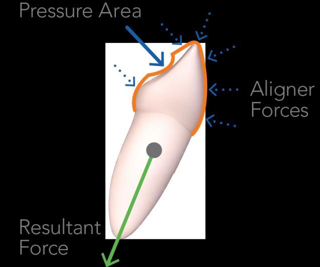 Pressure Area for Control of Anterior Intrusion THE PROBLEM THE SOLUTION v v Biomechanical testing shows that the intrusive force from aligners may not be directed along the long axis of the