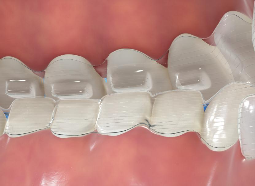 Precision Bite Ramps Precision bite ramps are prominences on the lingual surface of upper aligners (not filled with composite).