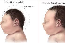Zika Virus During Pregnancy Microcephaly Microcephaly Intracranial calcifications Ventriculomegaly