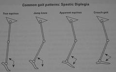 FOOT IN CEREBRAL PALSY GAIT IN CEREBRAL PALSY I True Equinus II Jump gait III Apparent Equinus IV Crouch gait Group I True Equinus Extended hip and knee Equinus at ankle II Jump Gait [commonest]