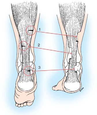 Diplegic Hips is internal rotation and adducted Knee is flexed and externally rotated Foot is in valgus Hemiplegia: Hip internal rotation But the knee comes into extension in the stance Foot assumes