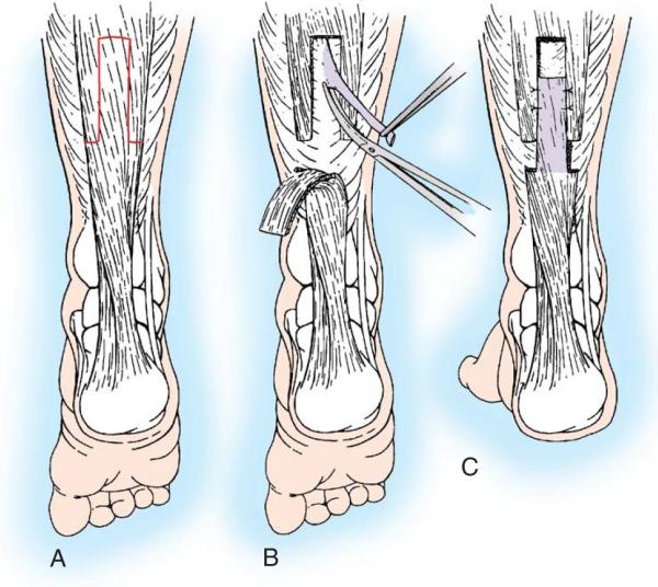 Its distal part is allowed to retract distally but is not sutured to the soleus.