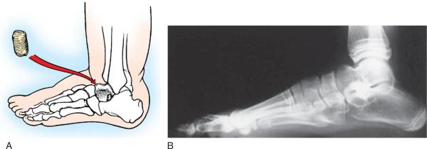 Calcaneal displacement osteotomy In fixed varus/valgus, a corrective osteotomy [Closed Dwyer] can be performed with or without a muscle balancing procedure.