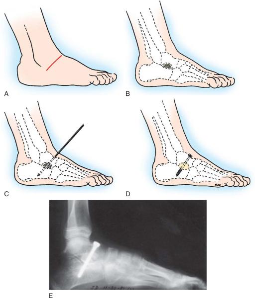 Now it is medial displacement calcaneal osteotomy with lateral column lengthening procedure, gaining the popularity. So that mobility of the subtalar joint is retained.
