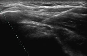 Sub-Acromial In-Plane Injection ACR ssp HUM In Plane Approach