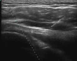 Lateral Approach : Full length reflection of needle is advanced to the
