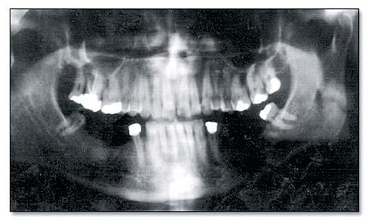 Figure 1. Panoramic radiograph of the patient. Figure 2. Transcranial radiograph of the right and left TMJ, respectively. The MRI was made of both joints in the mouth open and closed positions.
