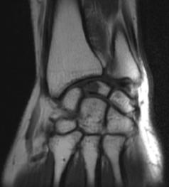 156 Figure 5: T1 weighted image showing hyperintense lesion in the lunate bone consistent with a cyst. A volar approach was taken 2.