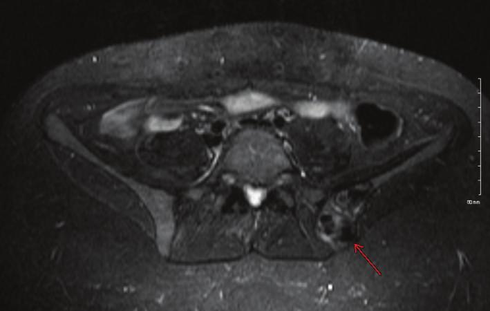 Case Reports in Obstetrics and Gynecology 3 (a) thin cortical osseous shell is represented by a low signal rim encirclingthecysticlesionont1-andt2-weightedimages.