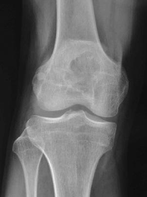 n ase Report T umors of the patella are rare. Only a few studies have reported these lesions, and most are case reports.