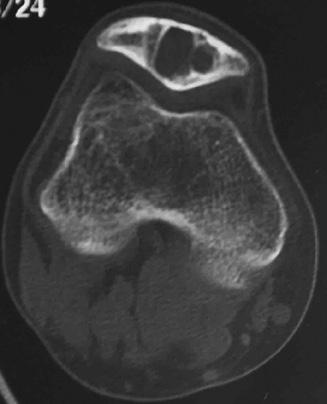 9,10 Secondary aneurysmal bone cysts are occasionally observed in giant cell tumor or chondroblastoma.