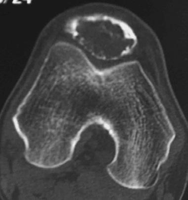 ase Report 36-year-old man reported a 2-year history of right knee pain aggravated by exercise and improved at rest.