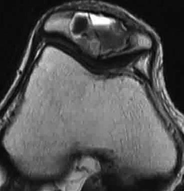 Plain radiographs demonstrated a radiolucent lesion in the right patella with well-defined, lobulated margins.