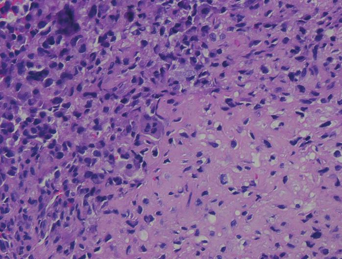 In the more cellular areas, the chondroid matrix was less obvious and the tumor cells were intermingled with multinucleated giant cells (hematoxylin-eosin stain; original magnification 20) ().