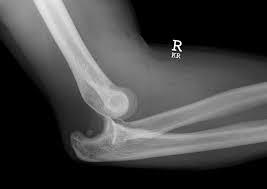 Dislocation of the Elbow Caused most often by either by a fall on the outstretched hand with the