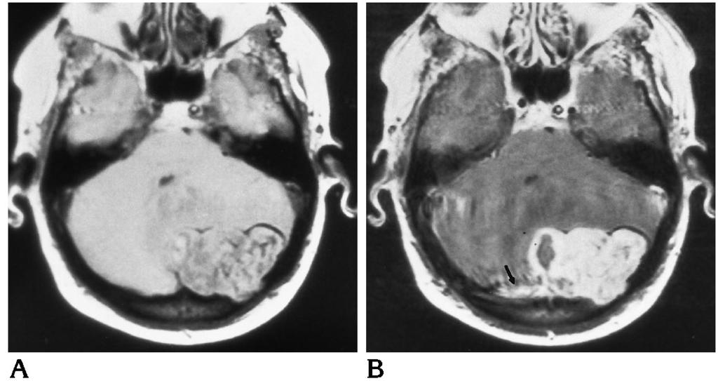 B, Axial contrast-enhanced T1- weighted MR image shows a heterogeneously enhancing lobulated mass. A dural tail sign is seen posteriorly and extending to the right of the mass (arrow).