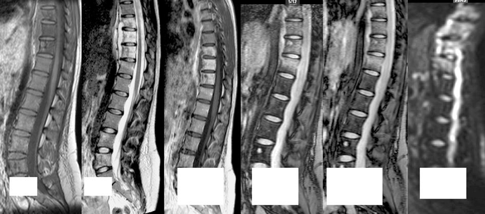 Role of Diffusion WIs & T 2 * GRE Pulse 261 T 1 In T 1 T 2 + Cont Out DWIs Fig. (12): Spondylodiscitis with diffusion restriction in DWIs.