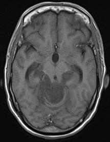 who revealed quite homogeneously increased signal intensity. Standard MRI showed an illdefined infiltrative lesion in the pineal region causing obstructive hydrocephalus.
