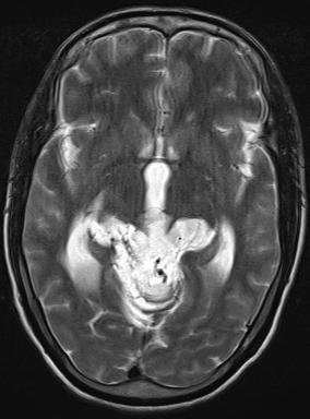 Although the ADCs of patients with low grade and high grade gliomas overlapped, the combination of routine image interpretation and ADC had a higher predictive value.