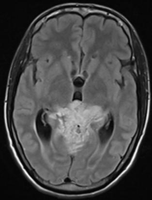 We believe that DWIs and ADCs can provide information useful to diagnose brain mass lesions that cannot be obtained with conventional MR imaging.