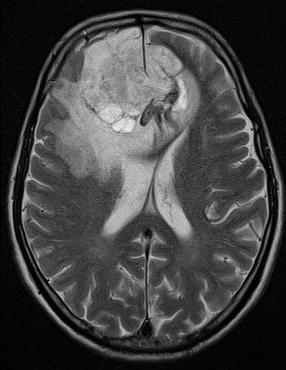 hyper intense lesion involving the pineal gland & tectal plate region