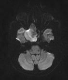 and ADC mapping 32 years male presents with severe headache and optic nerve at the