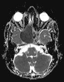 444 10 3 mm 2 /s)- MRI shows a well-defined peripherally enhancing Suggestive of