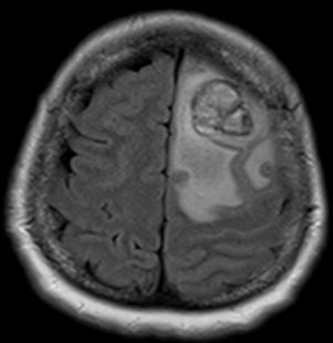 headache since 7 days left high frontal lobe showing diffusion restriction sudden in