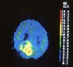 The radiotracer FDG 18 indicates: 1. cancers because they use larger amounts of glucose than normal tissue. 2.