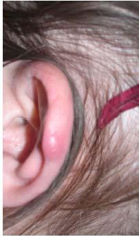 proliferation of the ear.
