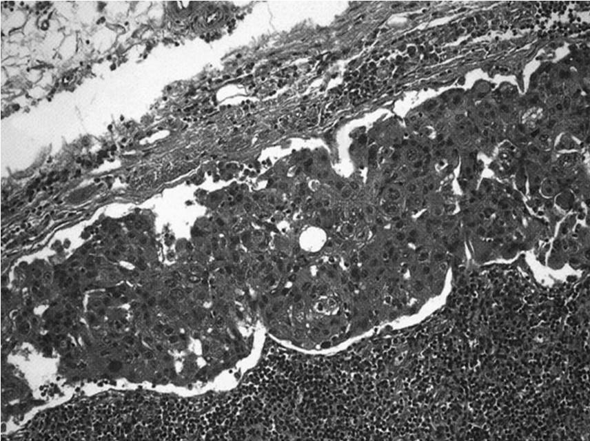MYELOID NEOPLASMS Neoplasms of hematopoietic stem cells Acute myelogenous leukemia (AML) accumulation of immature myeloid cells in bone marrow