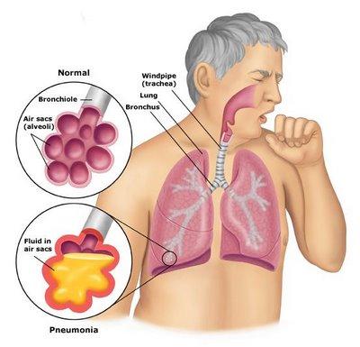 Signs & Symptoms Cough (with some pneumonias you may cough up greenish or yellow mucus, or even bloody mucus) Fever, which may be mild or high Shaking chills Shortness of breath, which may only occur