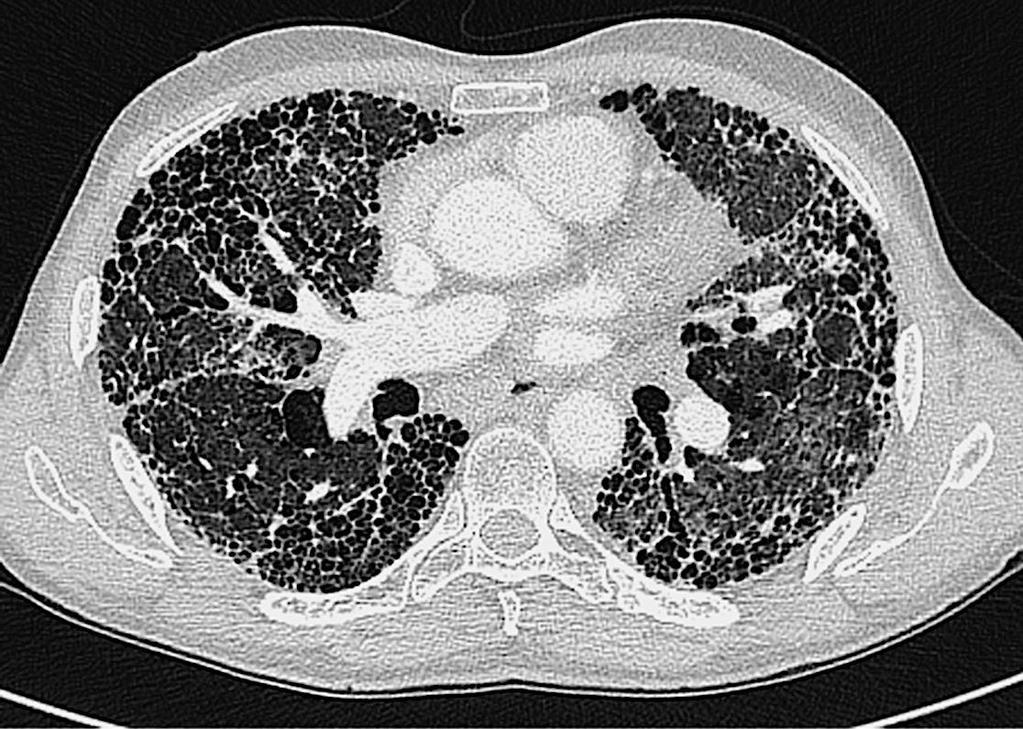 Pulmonary fibrosis?