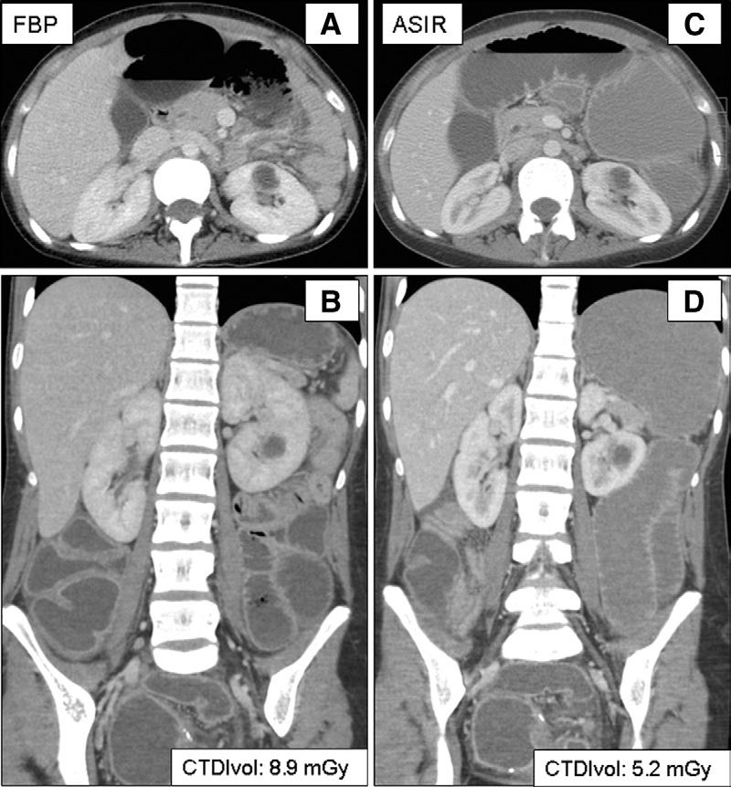 image appearance in any region, including the bony structures, with use of ASIR in pediatric CT examinations, as has been reported in prior studies (11 15).