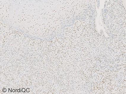 negative staining was seen in the breast carcinoma no. 5.