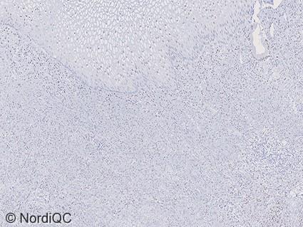 To validate the specificity of the IHC protocol further, an ER negative breast carcinoma must be included as primary negative tissue control, in which only remnants of normal epithelial and stromal