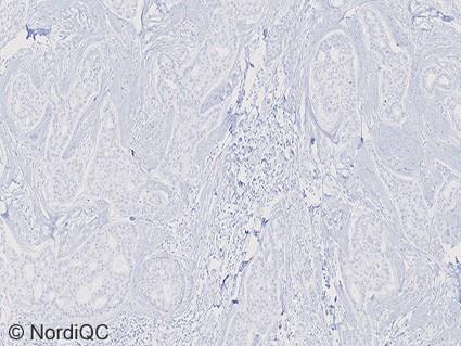 3b Insufficient ER staining of the breast ductal carcinoma no. 6 with expected 90 00% cells positive using same protocol as in Figs. b and 2b.