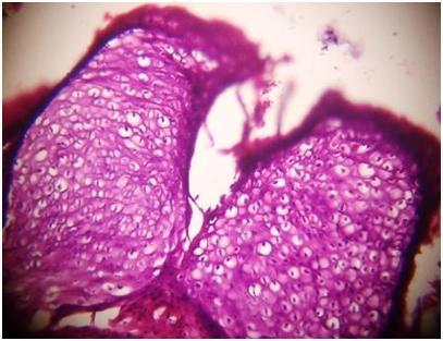 Verruciformis- a twenty one years old male patient who was diagnosed with lichen sclerosus et atrophicus like skin lesion over the left knee turned out to be epidermodysplasia verruciformis on