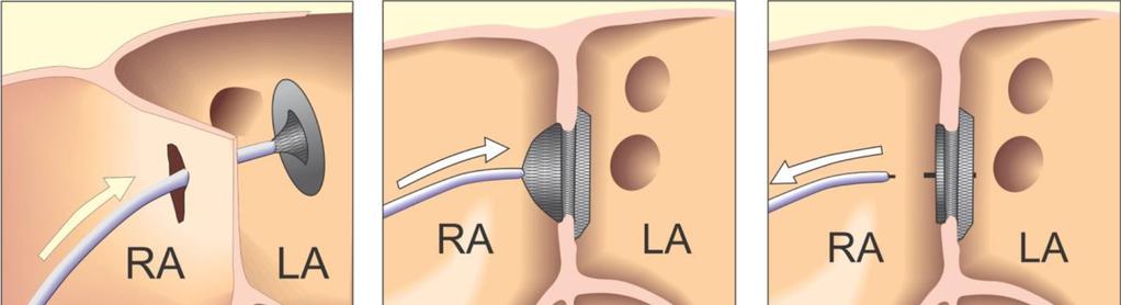 Figure 1. Diagram of the Steps of Procedures of Implantation of ASD Devices From Advancing to Left Atrium and Then Releasing After Device is Stable. RA, right atrium; LA, left atrium.