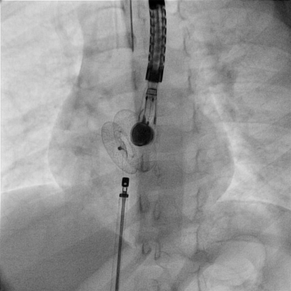 Similar devices of Lifetech were implanted in 3 patients. During the procedure the devices were attached to the delivery cable with a screw at the end of the device. Figure 2.