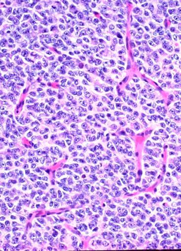 Oligodendroglioma Neoplastic cells resemble oligos: small, round Morphology no longer a criterion for classification WHO grades 2 or 3, never