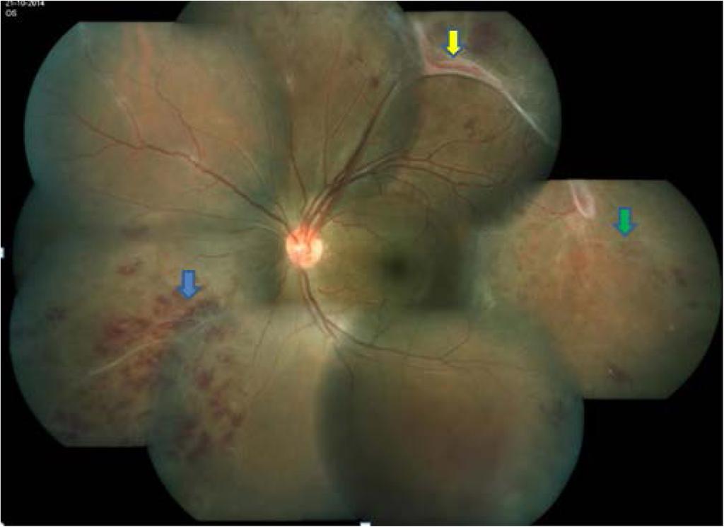 Kharel (Sitaula) et al. Journal of Ophthalmic Inflammation and Infection (2017) 7:4 Page 2 of 6 Eales' disease thereby leading to a better resolution of the disease and less number of recurrences.