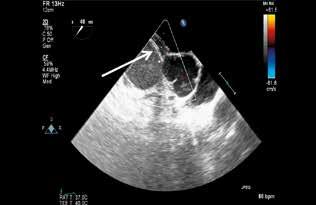 Figure 7. Transesophageal echocardiography image of the occluder immediately after implantation (white arrow) Figure 6. Occluder immediately after implantation (black arrow).