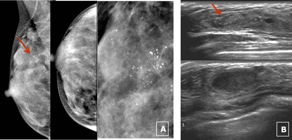 Fig. 3: Distribution of CHC on MG Fig. 4: Case 1. A 28-year-old woman with pathology proven FCC of right breast. A. MG (RCC, RMLO) reveals CHC with regional distribution in Rt.